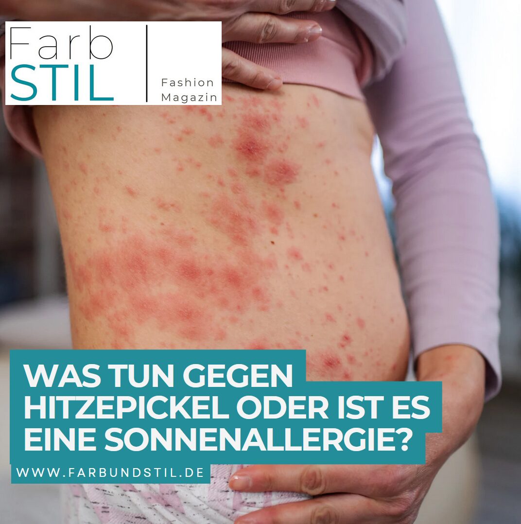 Was tun gegen Hitzepickel oder ist es eine Sonnenallergie? Was tun gegen Hitzepickel oder ist es eine Sonnenallergie?