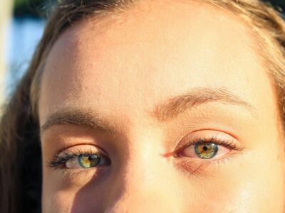 was tun gegen hitzepickel