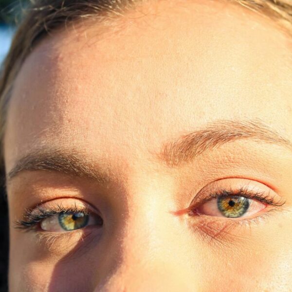 was tun gegen hitzepickel